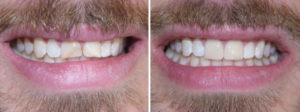Ricostruzione dei denti fratturati eseguita con nuove otturazioni estetiche