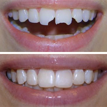 Ricostruzione dei denti: interventi conservativi e non invasivi (luglio  2021) - Antonella Udeschini - Estetica dentale: odontoiatria estetica e  cosmetica