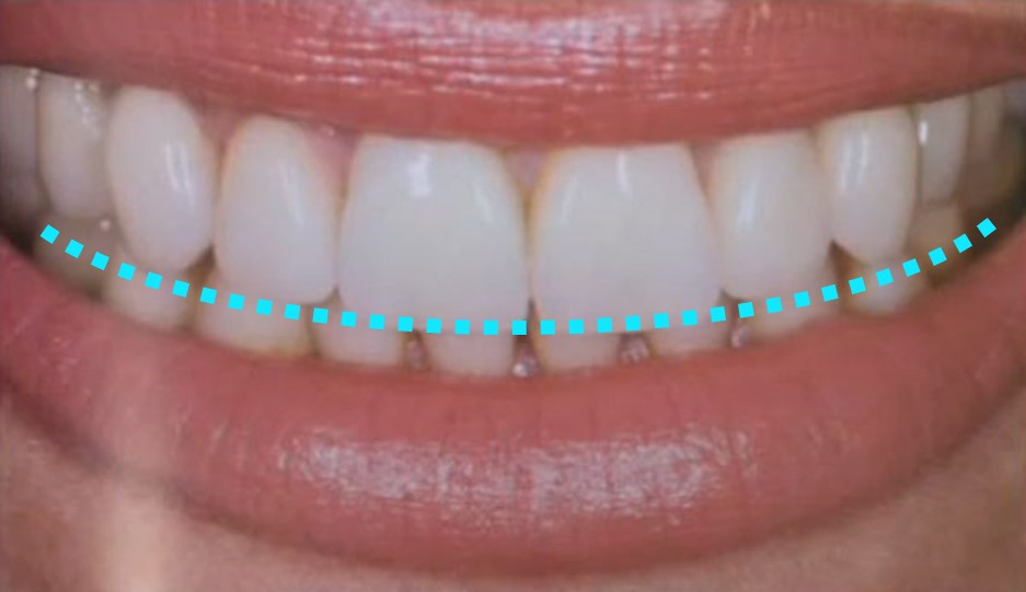 Denti Finti di Qualità - Scopri la Soluzione Perfetta
