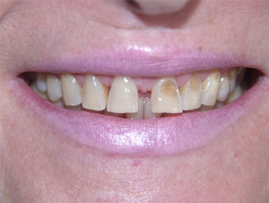 Diastema