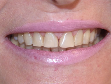 chiusura diastema e ricostruzione smalto