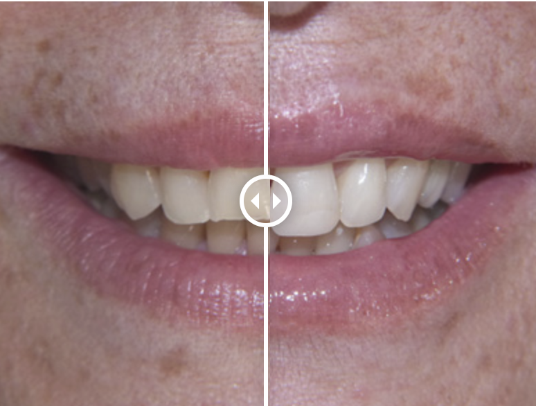 Denti consumati e usurati: cause, rimedi e interventi conservativi -  Antonella Udeschini - Estetica dentale: odontoiatria estetica e cosmetica